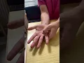 Trigger finger Transverse Friction