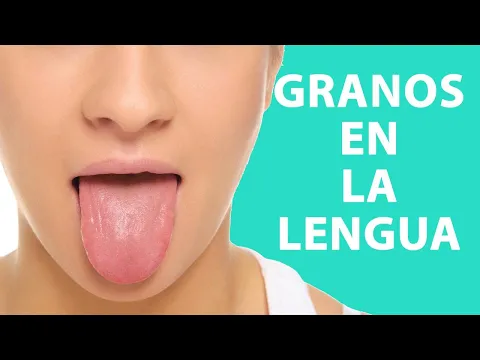 Download MP3 ¿CÓMO CURAR los GRANOS en la LENGUA?