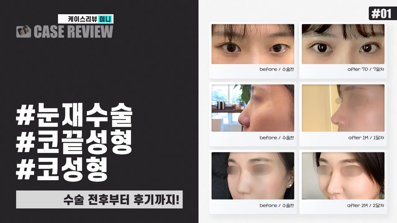 [케이스리뷰 미니] 수술 전후 + 100% 리얼 후기까지 딱 3분!  #눈재수술 #코끝성형 #코성형