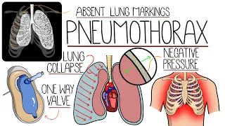Pneumothorax Explained Clearly