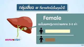 นิ่วในถุงน้ำดีเกิดจากสาเหตุหลักอะไร และมีสารใดบ้างที่ตกตะกอนจนกลายเป็นนิ่ว