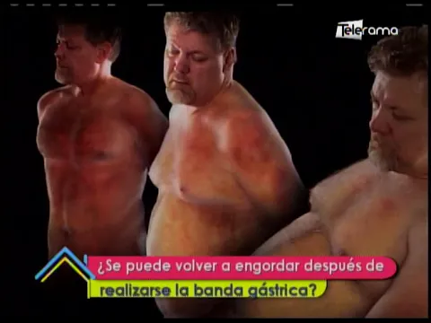 ¿Se puede volver a engordar después de realizarse la banda gástrica?