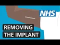Removing the contraceptive implant NHS