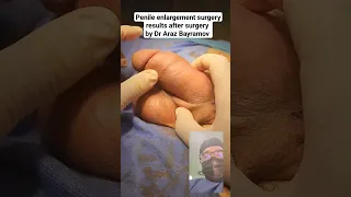 Penile Enlargement Surgery Results After Surgery By Dr Araz Bayramov Andrologist Urologist Draraz 