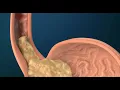 What Causes GERD