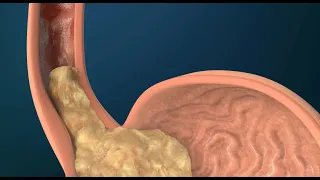 What Causes GERD