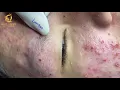 Treatment of acne tablets pustules and blackheads 360 Loan Nguyen