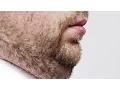 Double Chin Solution Through Non-Invasive Procedure