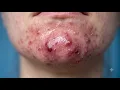Loan Nguyen Acne Treatment 35zz