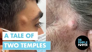 Dr. Pimple Popper vs. Two Temple Cysts