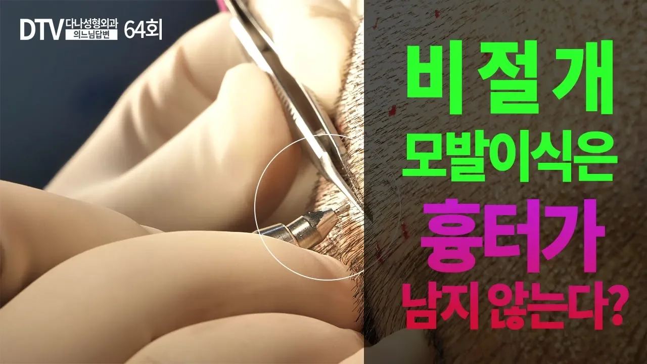 의느님답변📂ㅣ의느님답변 64회 - 비절개 모발이식은 흉터가 남지 않는다?