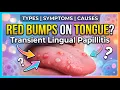 Transient Lingual Papillitis Types Symptoms Causes