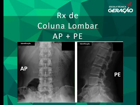 Download MP3 Radiografia da Coluna Lombar - AP + Perfil - Ortostática