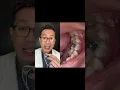 Download Lagu What is this Hole in this Person Tooth?
