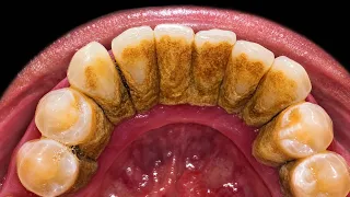 Satisfying Tartar Removal at the Dentist.