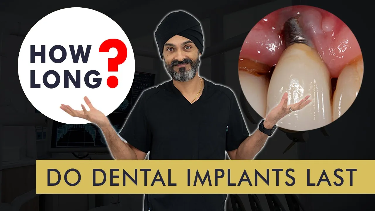 Outline Video How Long Do Dental Implants Last?