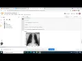 Convolutional Neural Network Pneumonia Prediction Model predicts this Xray Image is Normal