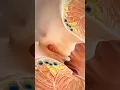 Download Lagu Anal Fissure Laser Surgery Treatment #viral