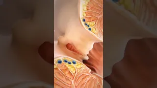 Anal Fissure Laser Surgery Treatment Viral 