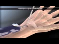 Endoscopic Carpal Tunnel Release