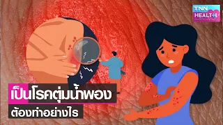การดูแลตนเองสำหรับผู้ป่วยตุ่มน้ำพองควรทำอย่างไรบ้าง