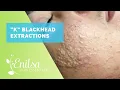 Blackheads Whiteheads Extractions on K Part 1