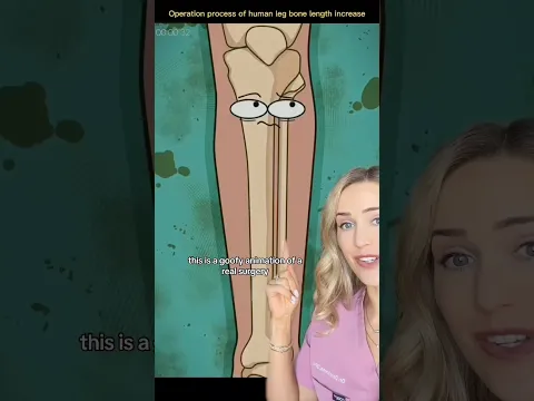 How this surgery makes you taller!