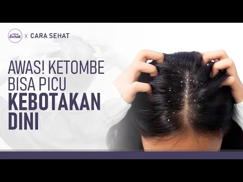 Ketombe Picu Rambut Rontok Hingga Kebotakan, Ini Cara Mengatasinya