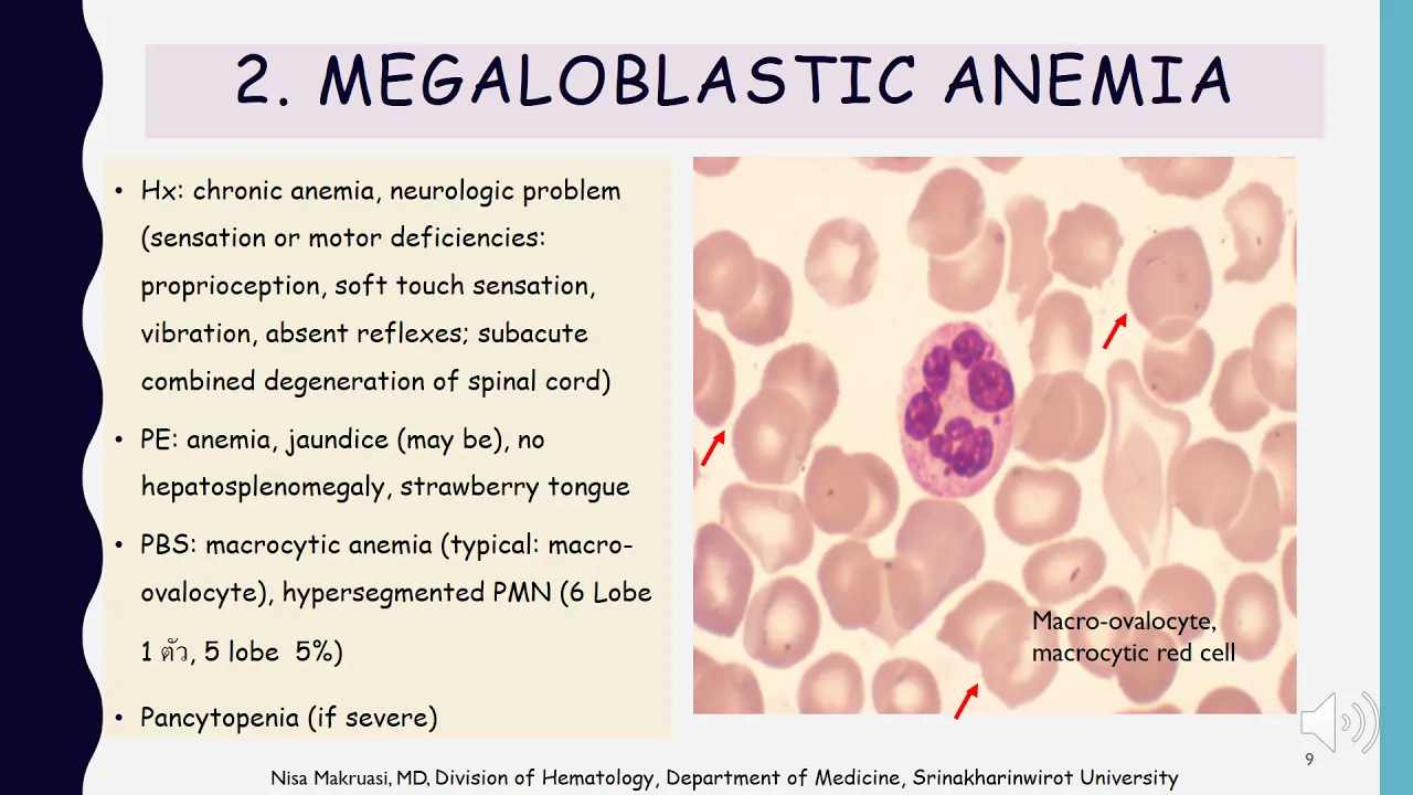 การอ่านสไลด์ blood smear ตอนที่ 3 (How to read a blood smear: case based approach)/nisa hematoswu