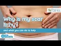 Why Does Your C-Section Scar Itch Explained by HLP Therapy