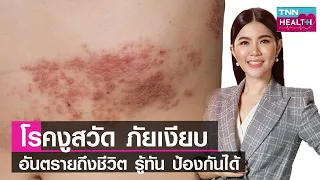 โรคงูสวัสดิ์เกิดจากสาเหตุอะไร และมีลักษณะอาการอย่างไรบ้าง