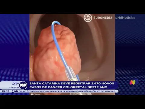 SC deve registrar 2.470 novos casos de câncer colorretal neste ano