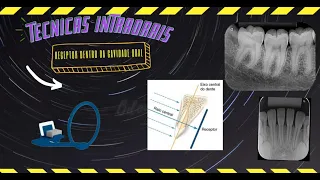 Técnicas radiográficas Intraorais (Periapical, Interproximal, Oclusal)
