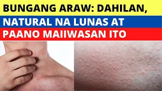 Download Bungang Araw : Dahilan, Natural Na Lunas At Paano Ito Maiiwasan MP3