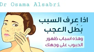 اسباب ظهور الحبوب على وجهك حبوب الوجه 