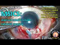 Download Lagu MSICS: manual small incision cataract surgery