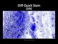 Rapid On-Site Evaluation of EBUS-TBNA