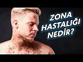 Download Lagu Zona Nedir? Vücutta Neden Zona Çıkar? - 2 Dakikada Sağlık