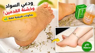 ملعقتان خل و تخلصي من إسمرار اليدين والأرجل و التشققات من الإستعمال الأول و إلى الأبد مضمونة ومجربة