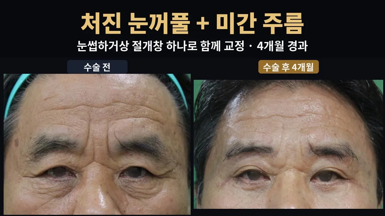 눈썹하거상 + 측두부 리프팅 + 미간 주름 교정 + 하안검, 60대 남성 4개월 기록#눈썹하거상 #눈썹하거상흉터 #측두부리프팅 #미간주름 #상안검처짐 #하안검 #눈밑지방재배치