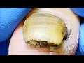 Lagu Trash under your toenails Thorough pedicure【Xue Yidao】