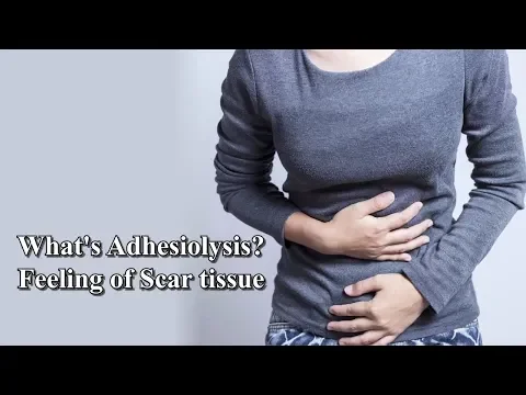 Download MP3 Laparoscopic Adhesiolysis \u0026 What does scar tissue feel like?- Dr. Sireesha Reddy