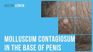 molluscum contagiosum in the base of penis