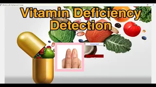 AI-Powered Detection of Vitamin Deficiencies through Convolutional Neural Networks Python Projects