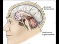 Chirag Patil MD explains Pineal Cyst Management