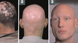 ผมร่วงเป็นหย่อม หรือ Alopecia areata มีลักษณะเฉพาะอย่างไร และสามารถสังเกตได้จากอะไรบ้าง